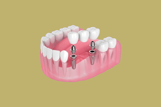 Dental implants in Bhiwani