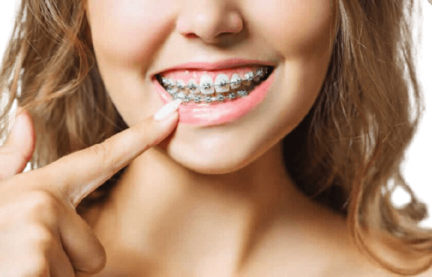 Braces and aligners in Bhiwani