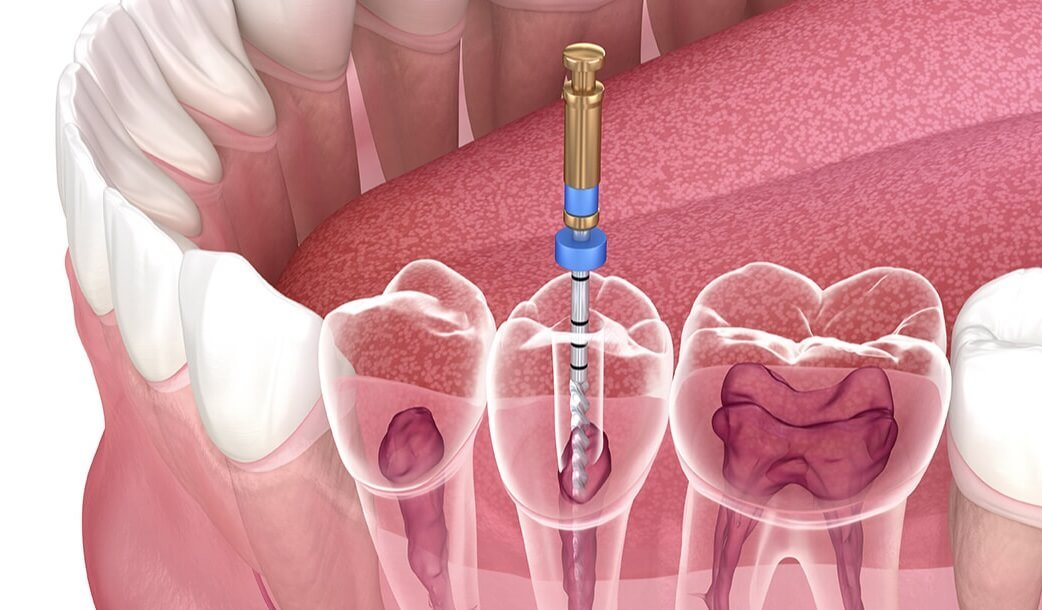 Painless root canal treatment in Bhiwani