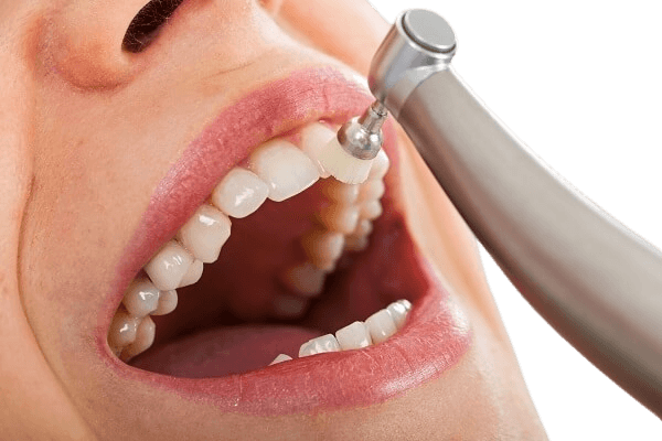 Teeth cleaning and whitening in Bhiwani